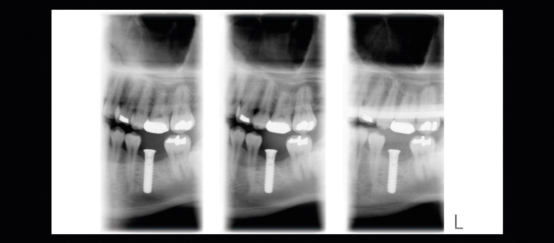 Longitudinal tomography