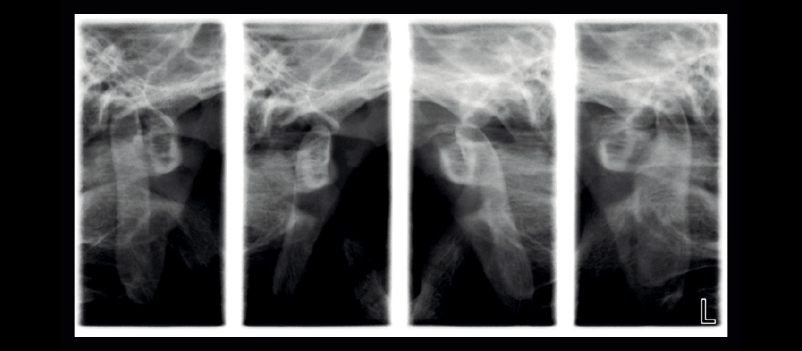Lateral TMJ (closed & open)