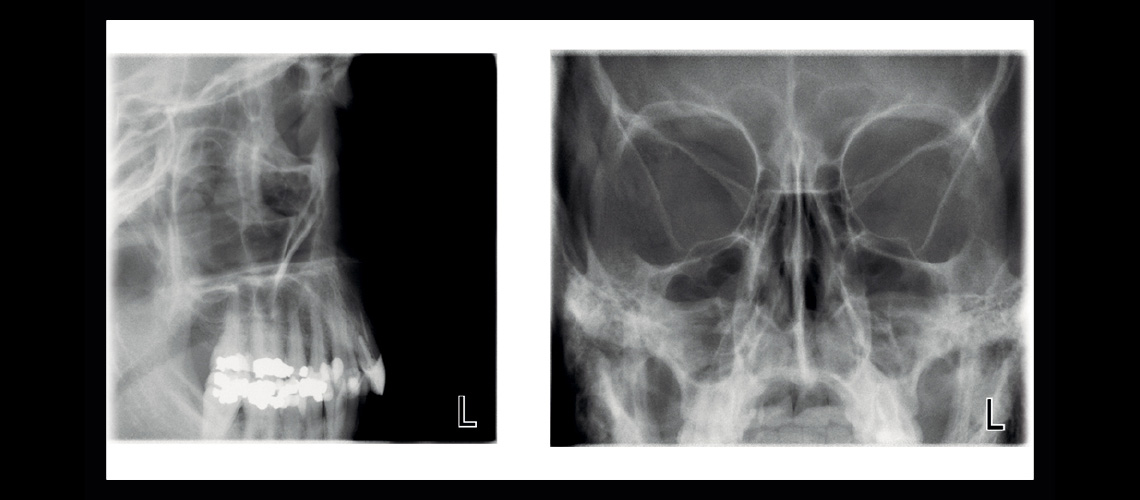 Lateral non-rotational sinus and PA non-rotational sinus