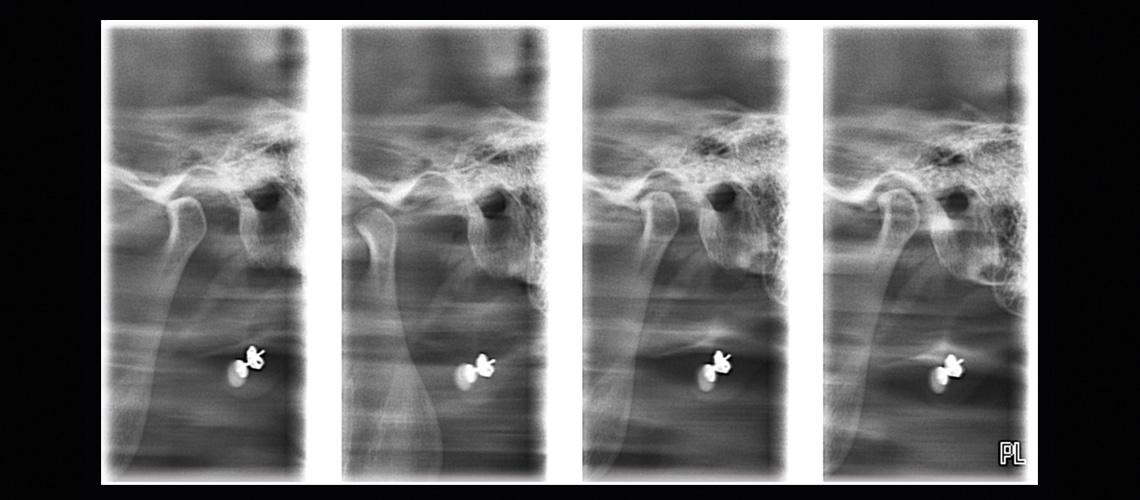Longitudinal tomography