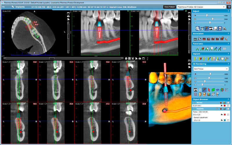 Planmeca ProMax 3D Classic Implant case