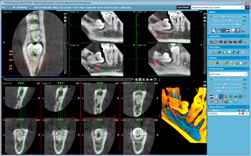 Planmeca ProMax 3D Classic Wisdom tooth