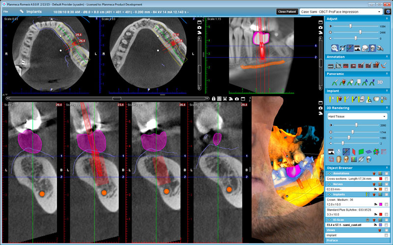 Planmeca ProMax 3D Classic 3D implant with crown