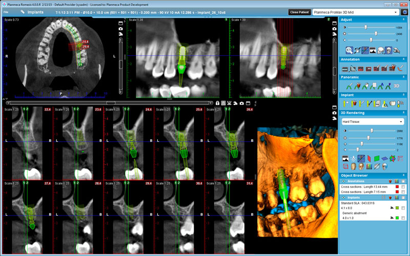 Planmeca ProMax 3D Mid Implant planning