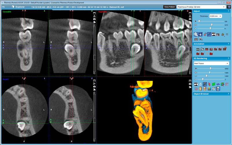 Planmeca ProMax 3D Mid retired premolar