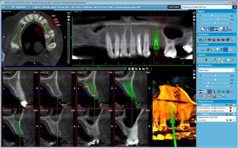 Planmeca ProMax 3D Plus Implant planning