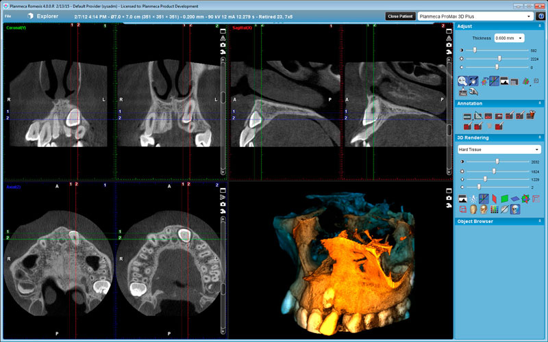 Planmeca ProMax 3D Plus Orthodontic case