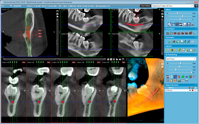 Planmeca ProMax 3D Plus wisdom tooth