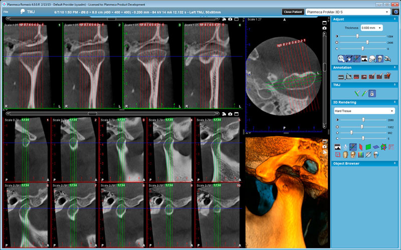 Planmeca ProMax 3D s TMJ study