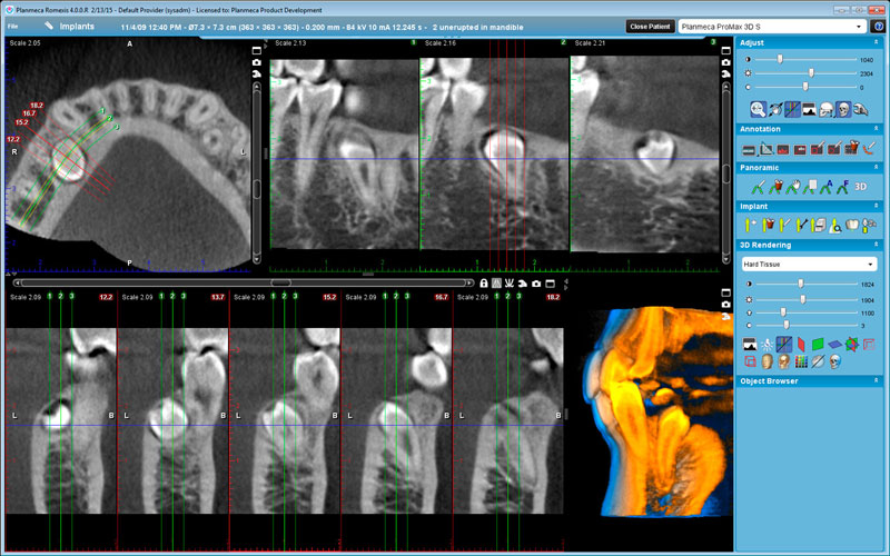 Planmeca ProMax 3D s Orthodontic case