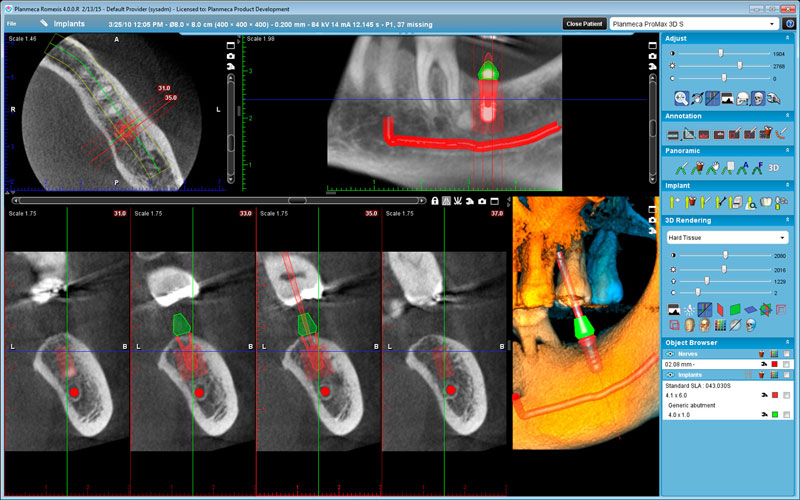 Planmeca ProMax 3D s Implant planning