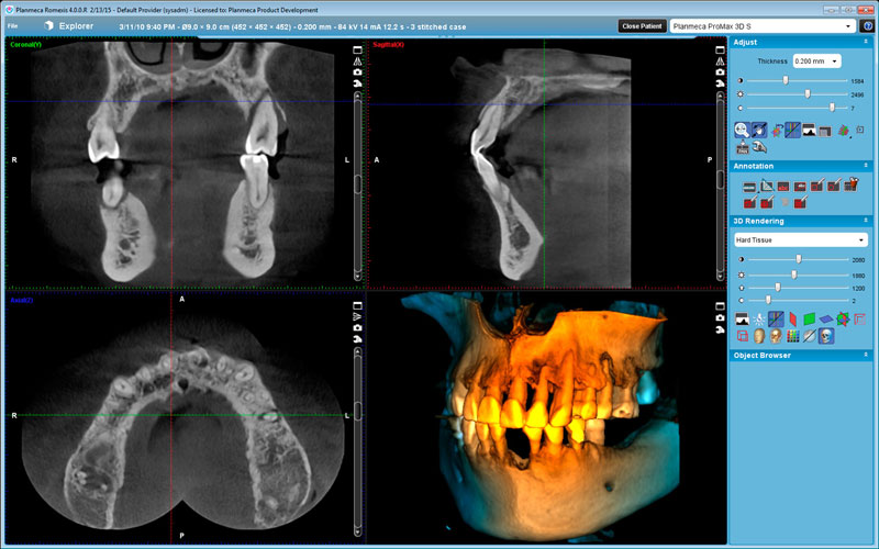 Planmeca ProMax 3D s stiched volume