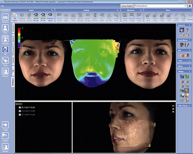 Planmeca ProFace before and after comparison