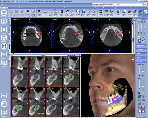 Planmeca Romexis Implant module