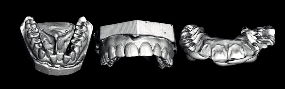 Scanned impressions of upper and lower arches and bite index in 3D
