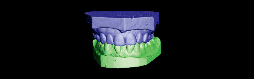 Upper and lower arch models in occlusion