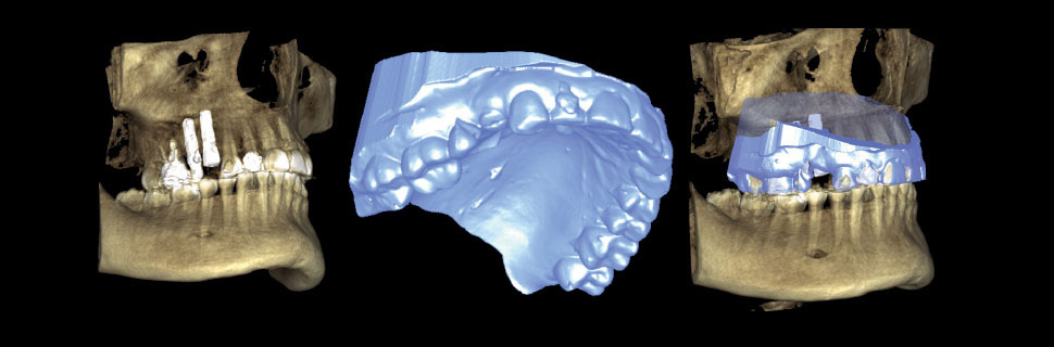 Superimposed CBCT and 3D model of upper jaw