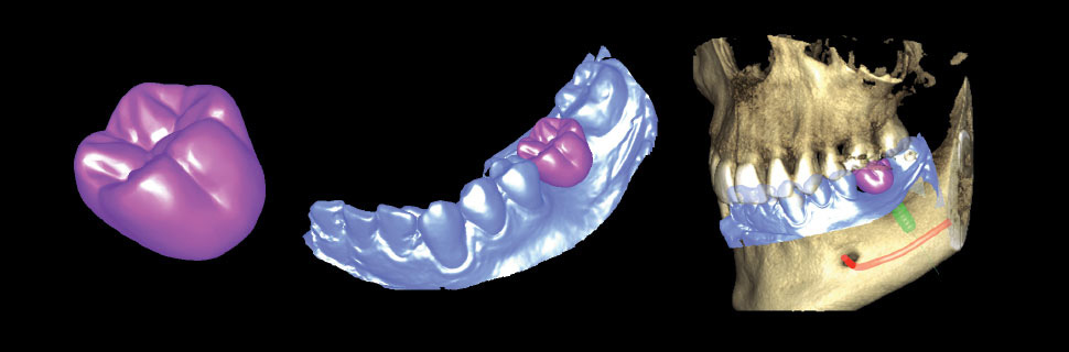 Crown, impression scan, and CBCT for more accurate implant planning