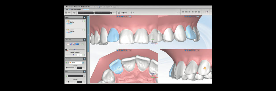 Analyse the STL data further in the Planmeca Romexis® 3D Ortho Studio module