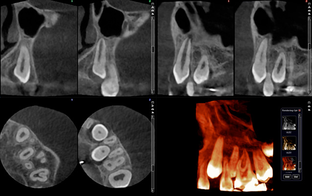 Planmeca Ultra Low Dose