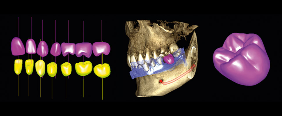 Use the Planmeca Romexis® crown library or import patient-specific crown from the CAD system to the software.