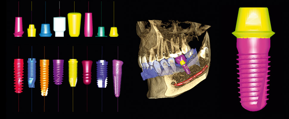 Use the extensive Planmeca Romexis® implant and abutment library to finalise the plan. Verify the plan with the implant verification tool.
